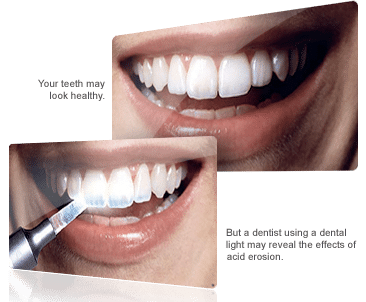 signs of acid erosion on teeth
